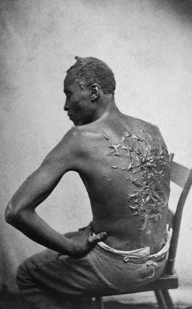 Scars on the back of a Mississippi slave distributed by abolitionists in order to gain support.