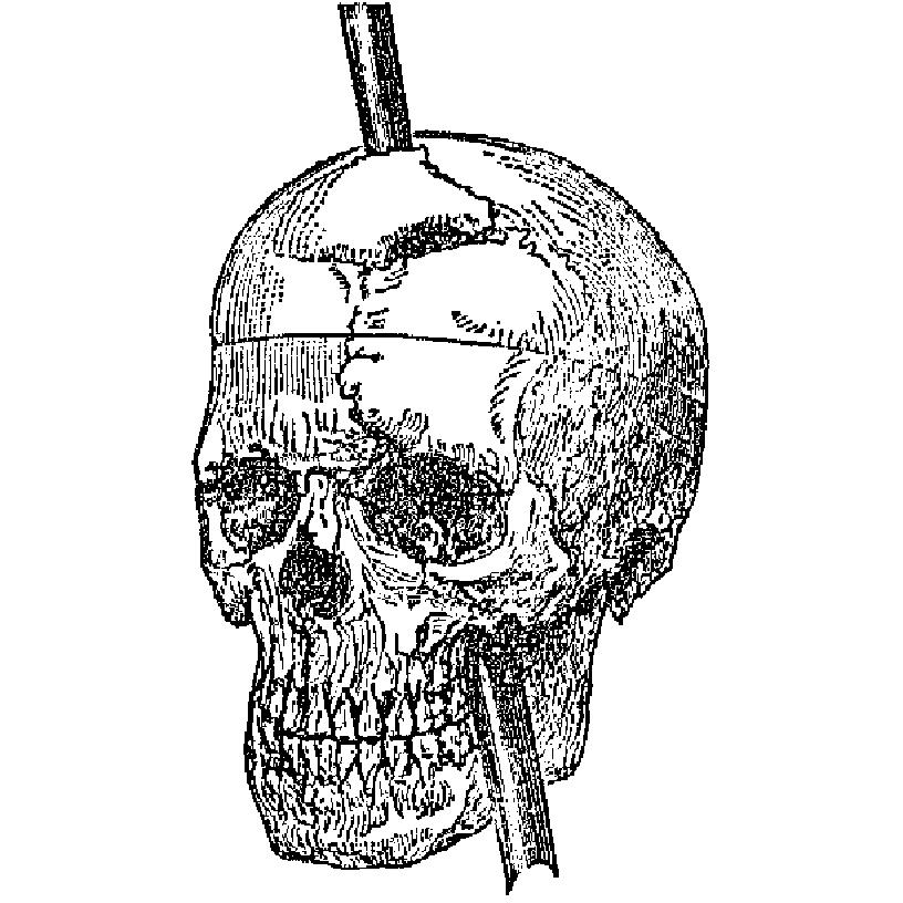 Front and lateral view of the cranium, representing the direction in which the iron traversed its cavity; the present appearance of the line of fracture, and also the large anterior fragment of the frontal bone, which was entirely detached, replaced, and partially re-united.